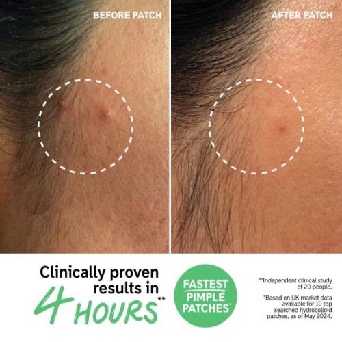 The INKEY List Hydrocolloid Invisible Pimple Patches